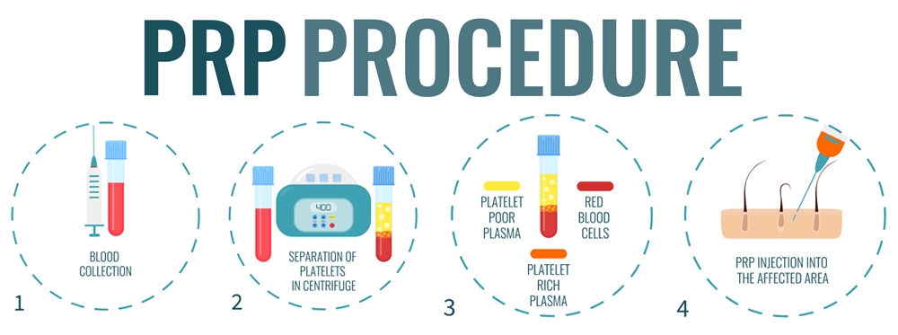 How Long Does PRP Take to Show Results