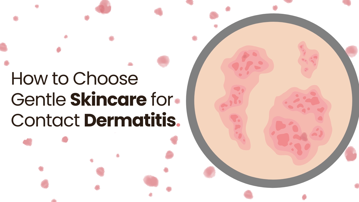 How to Choose Gentle Skincare for Contact Dermatitis.